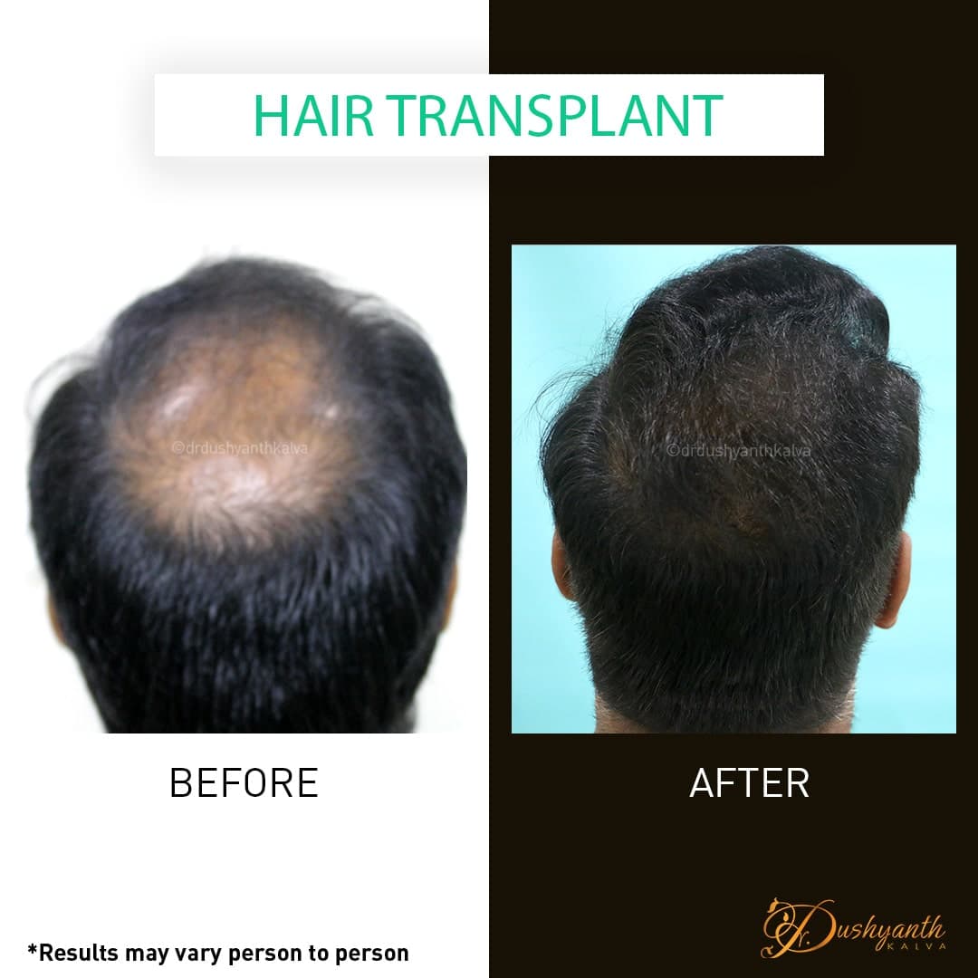 Hair transplant before and after result 02