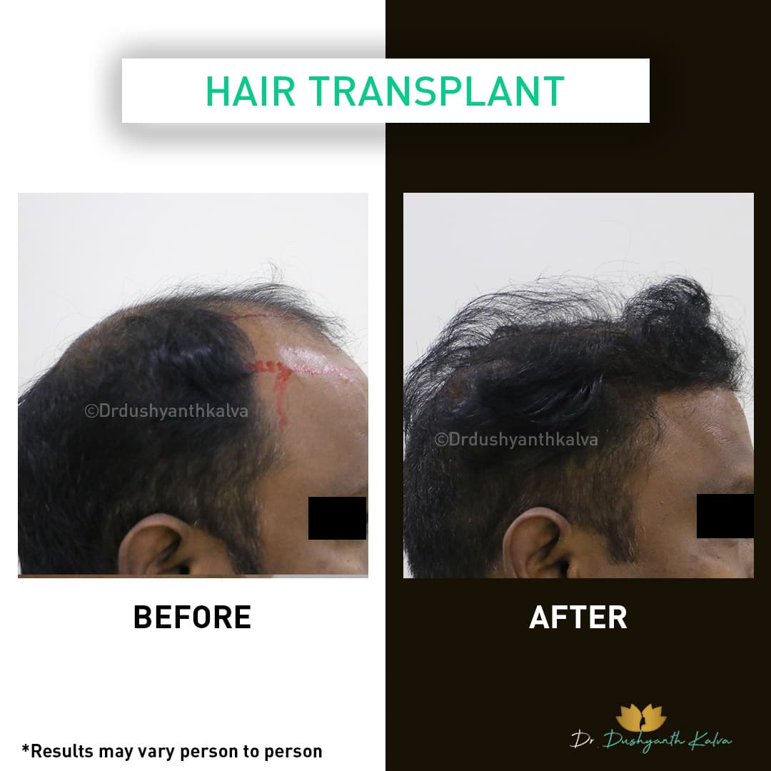 Hair transplant before and after result 11
