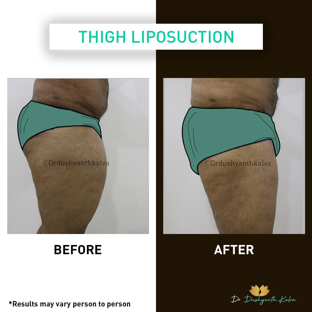 Liposuction before and after result 06