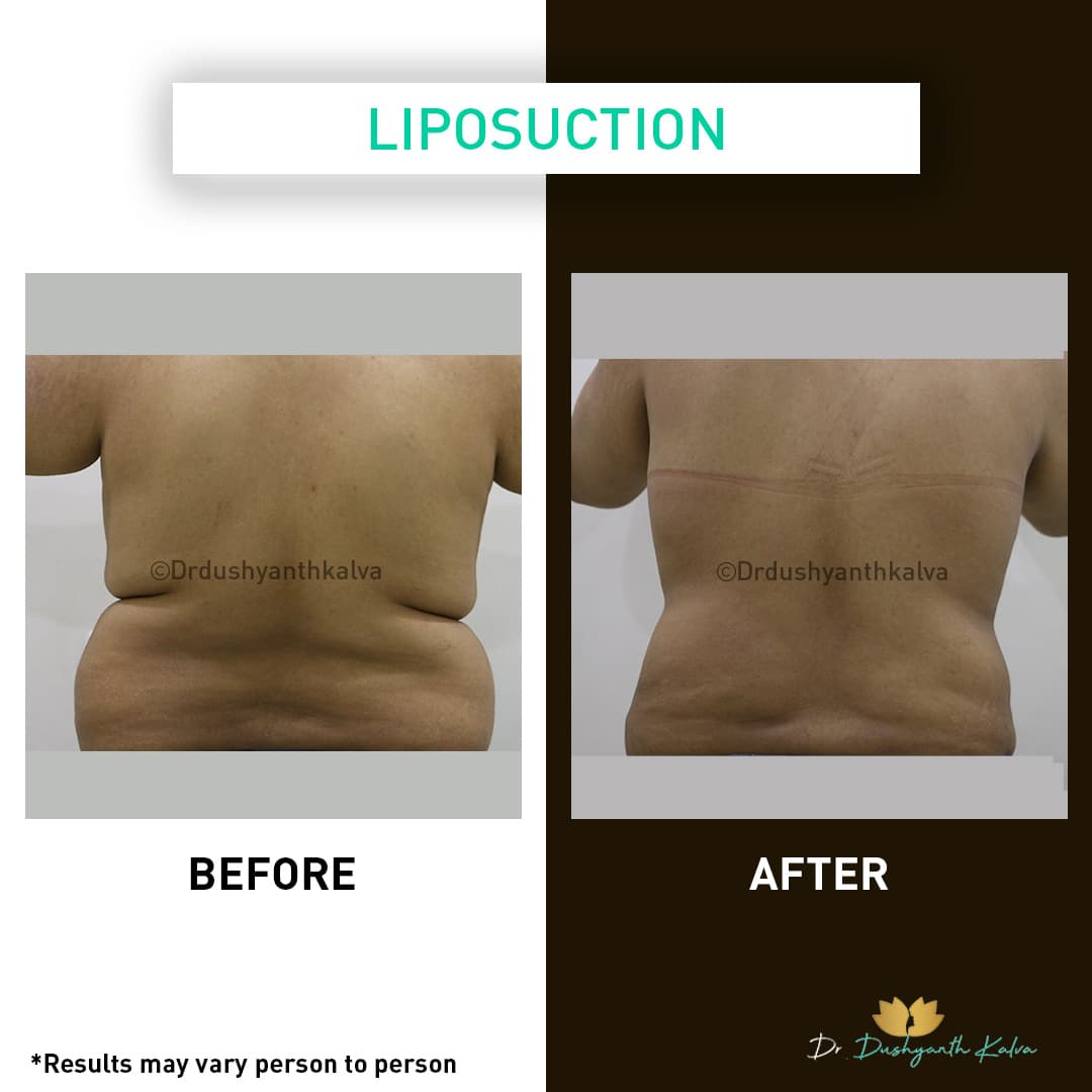 Liposuction before and after result 07