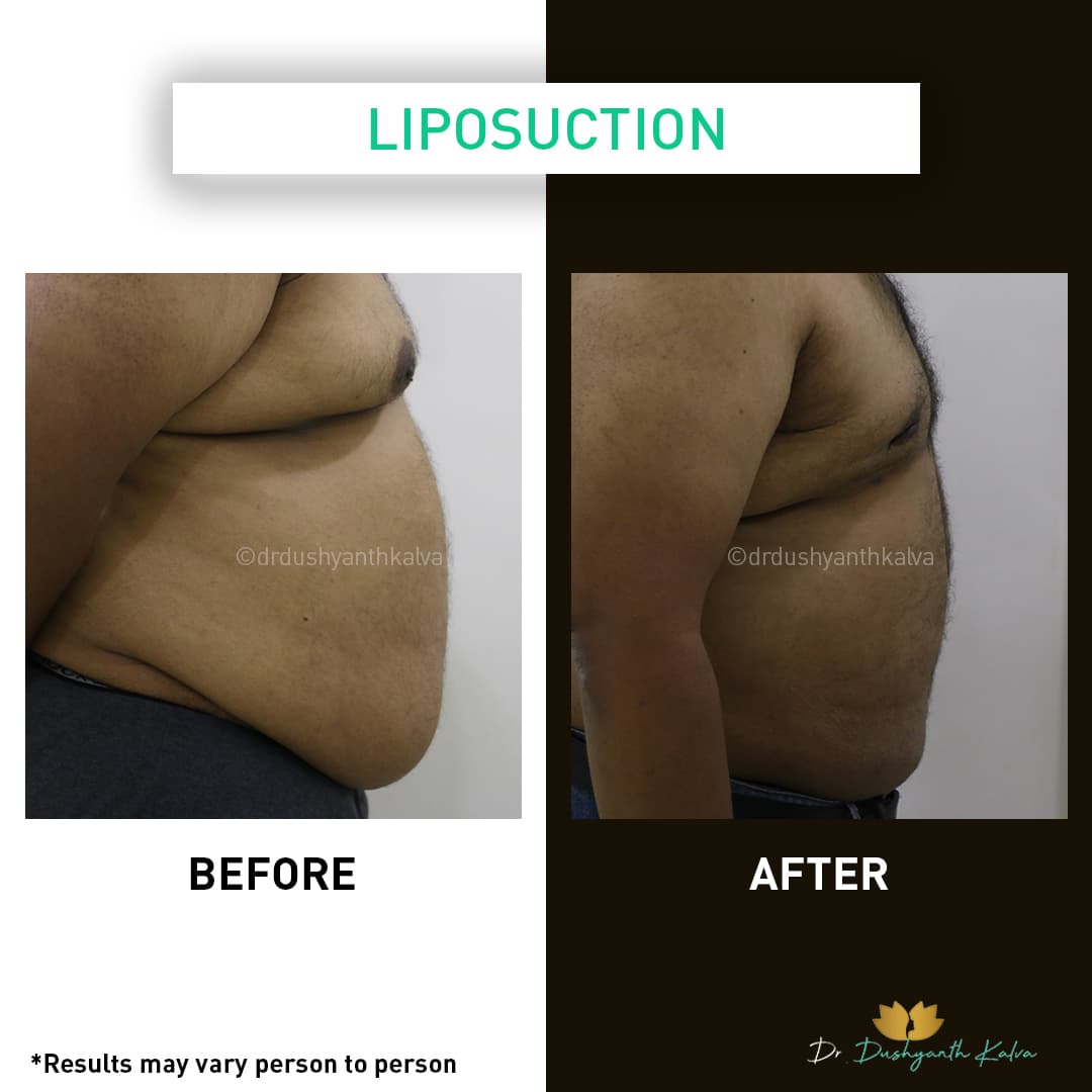 Liposuction before and after result 09