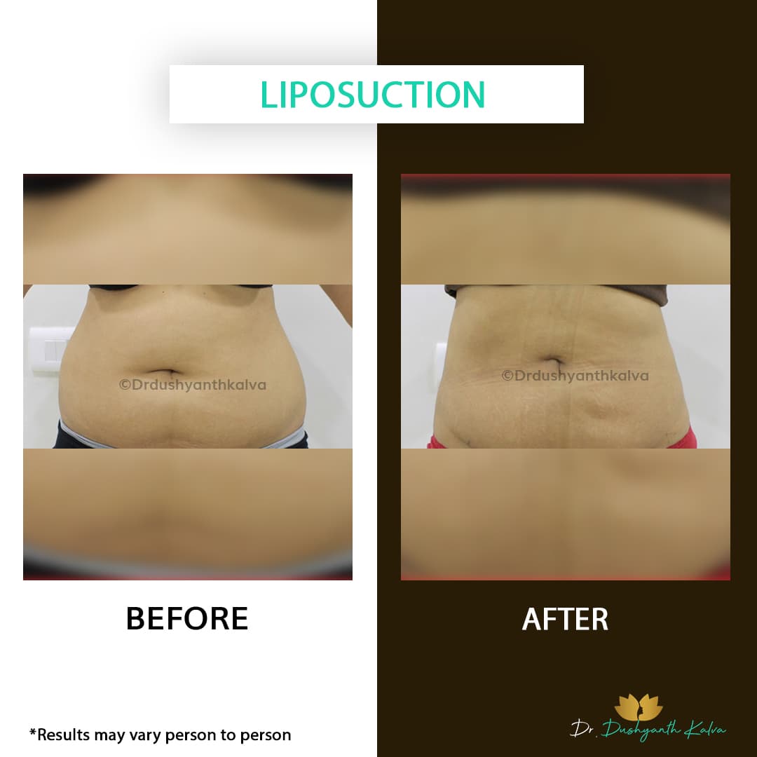 Liposuction before and after result 02