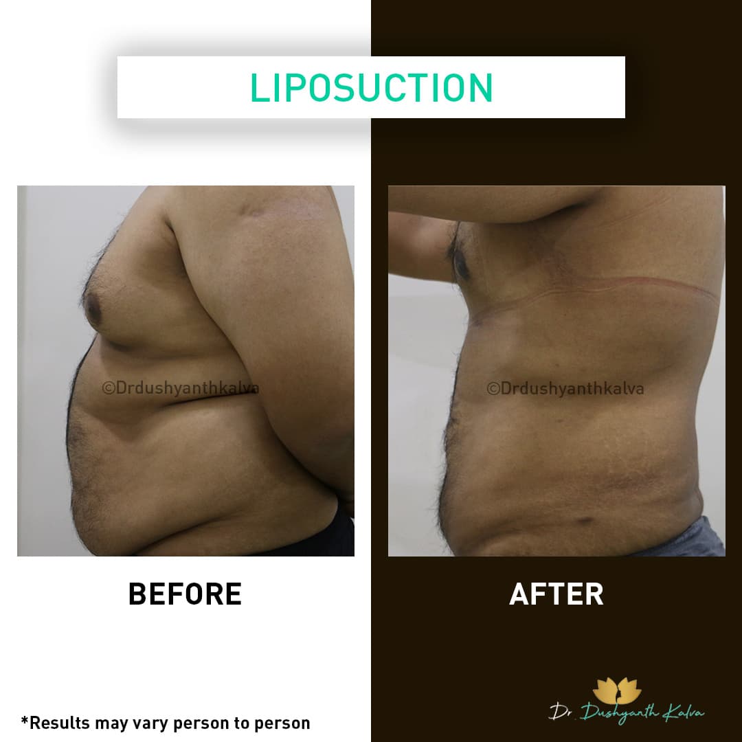 Liposuction before and after result 08