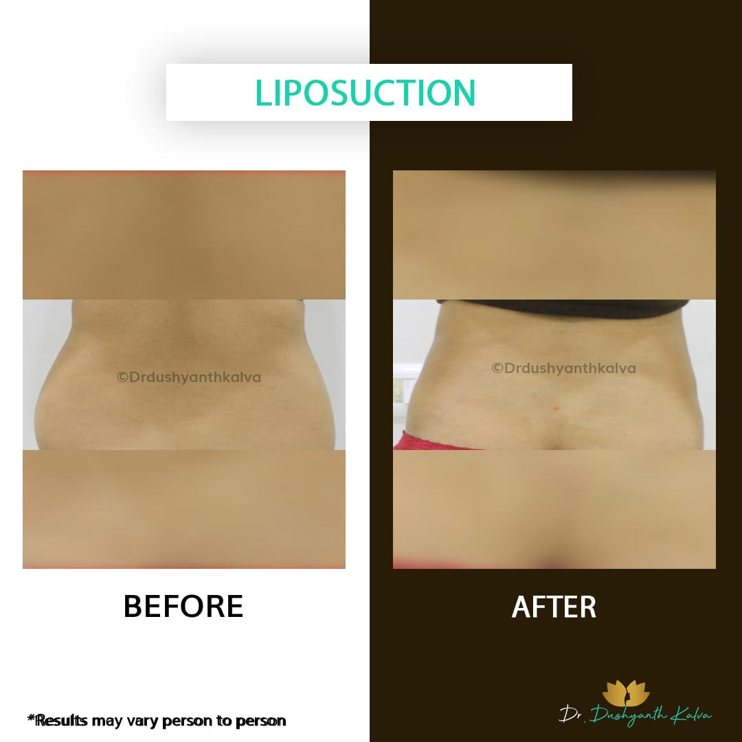 Liposuction before and after result 03