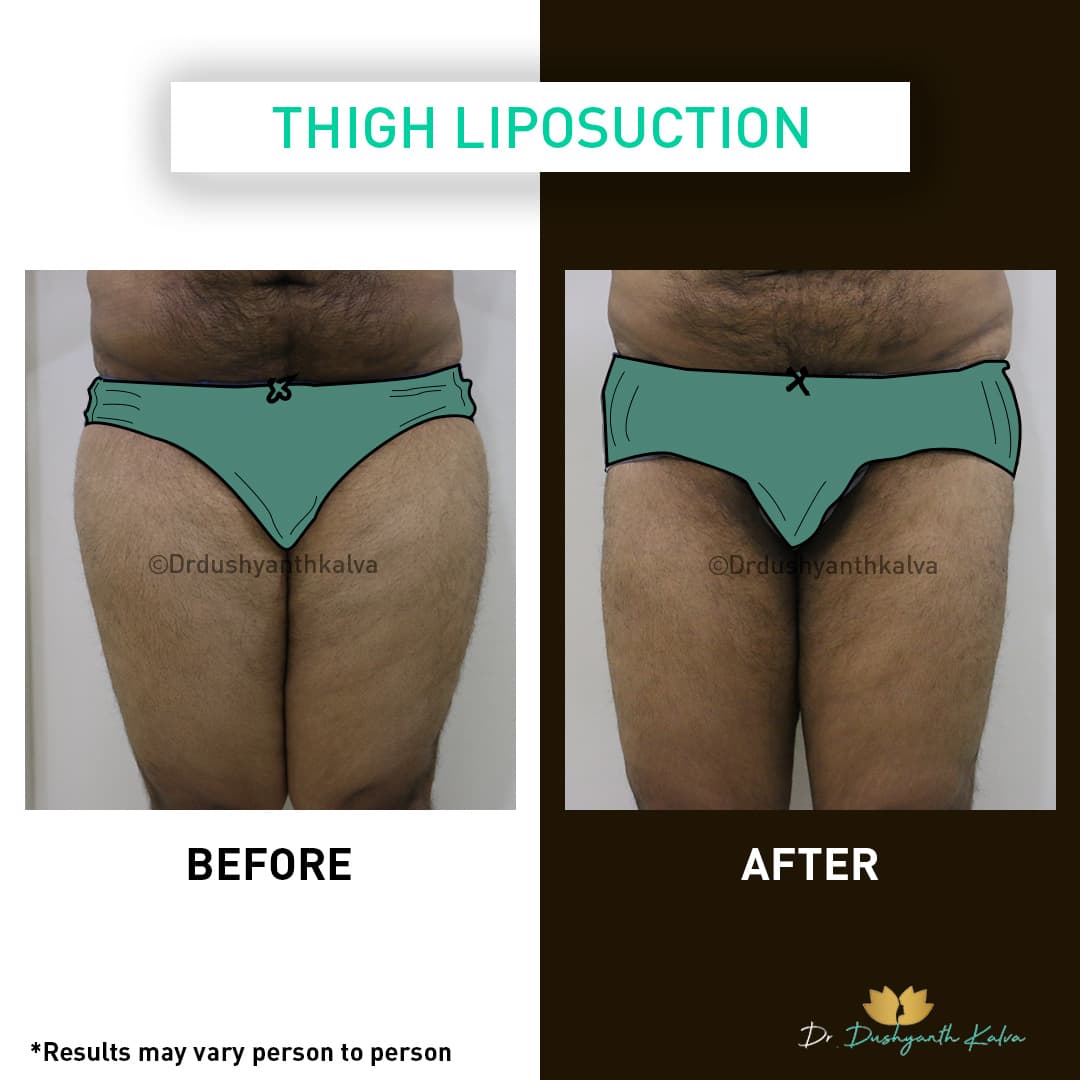 Liposuction before and after result 05