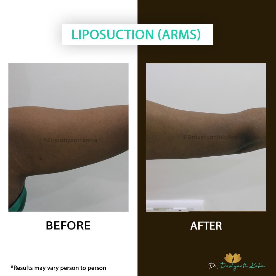 Liposuction before and after result 04
