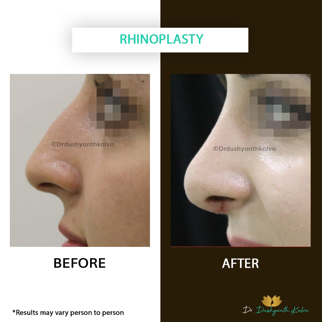 Rhinoplasty before and after result 02