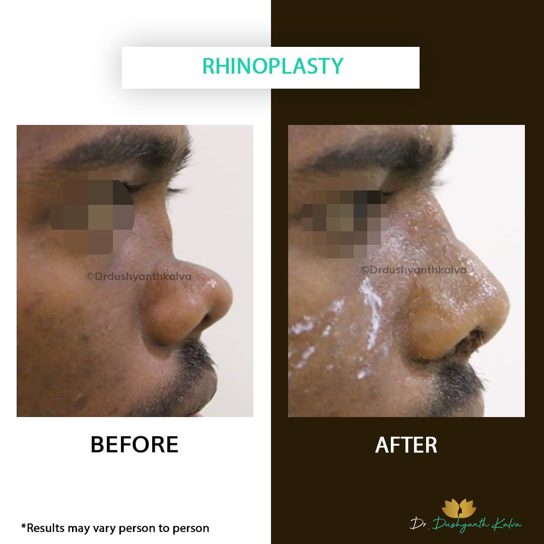 Rhinoplasty